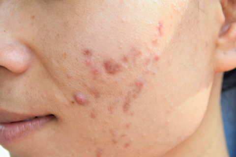 Como lidar com a acne na adolescência e não transformar as espinhas em uma ruína social