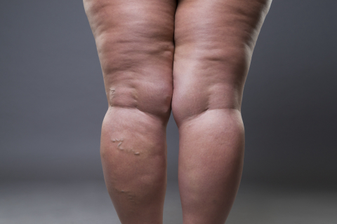 Acúmulo de gordura excessivo nas pernas pode ser sinal de lipedema; saiba identificar