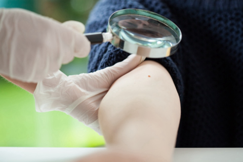 Quase 80% dos brasileiros desconhecem o tipo de câncer de pele mais mortal