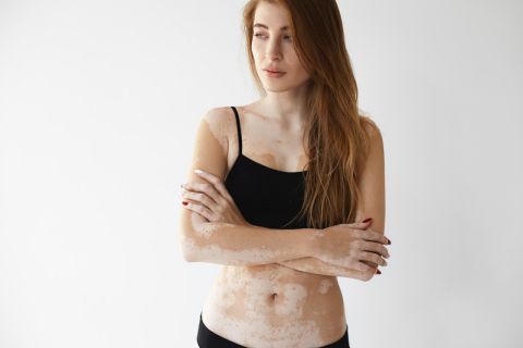 Tratamento de vitiligo pode até mesmo incluir despigmentação total