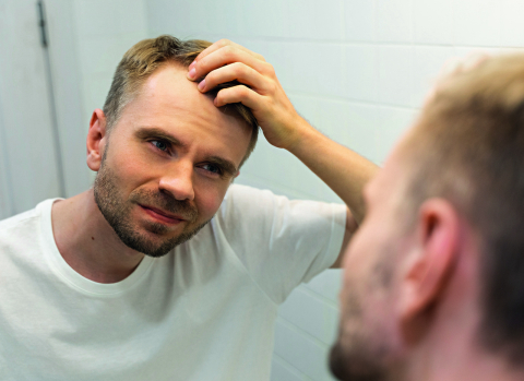 Evolução da dermatologia permite tratar a calvície precocemente